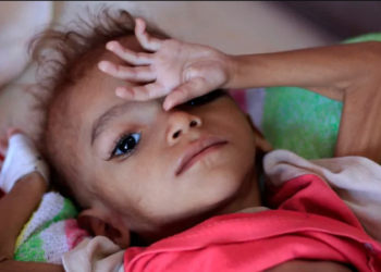 A Yemeni child suffering from malnutrition lies on a bed at a treatment centre in a hospital in the capital Sanaa